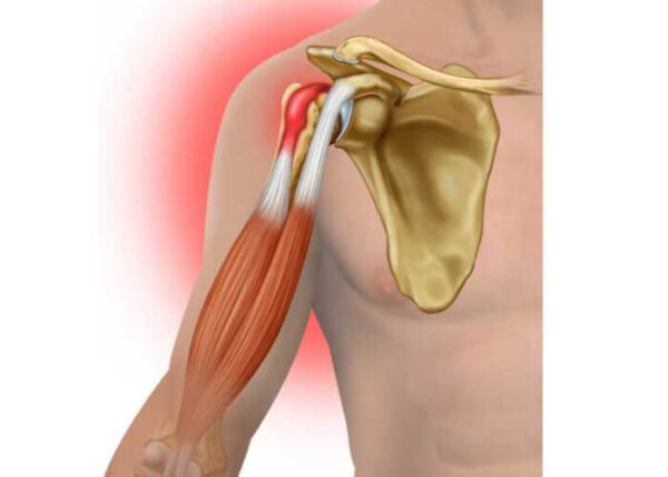 Biceps Tendonitis | Austin TX