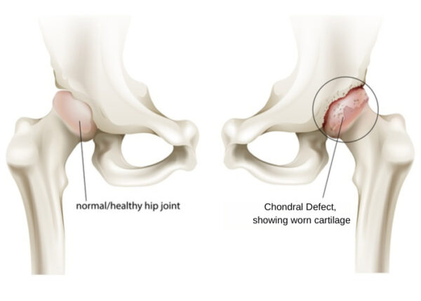 Chondral Defect | Austin TX