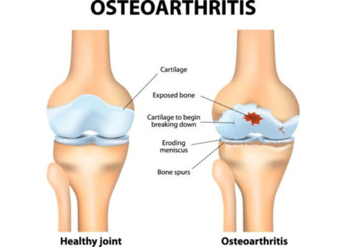 Osteoarthritis | Austin TX