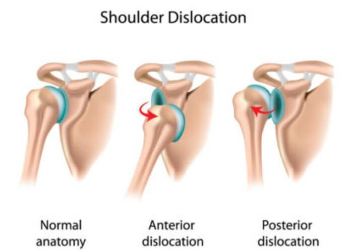 Shoulder Dislocation | Austin TX