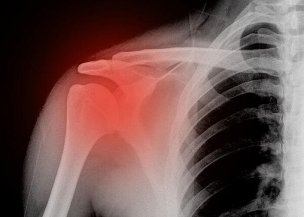 Shoulder Fracture | Austin TX