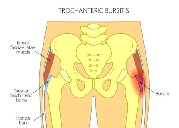 Trochanteric Bursitis | Austin TX