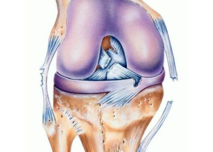 Multi-Ligament Knee Reconstruction | Austin TX
