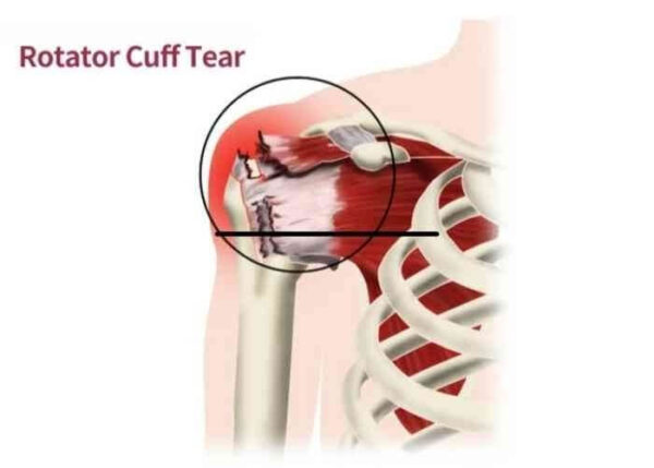 Rotator cuff online tear repair