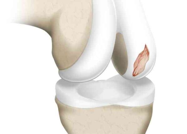 Articular Cartilage Injury Repair | Austin TX