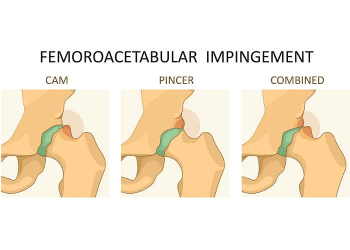 Dejlig gradvist Seneste nyt Acetabuloplasty | Pincer Impingement Treatment | Austin, Round Rock, Cedar  Park TX