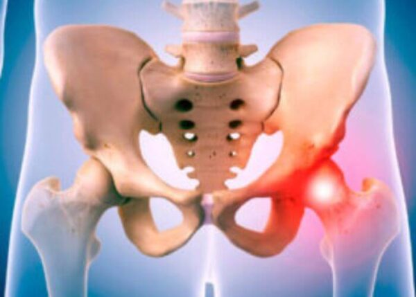 Hip Arthroscopy | Austin TX