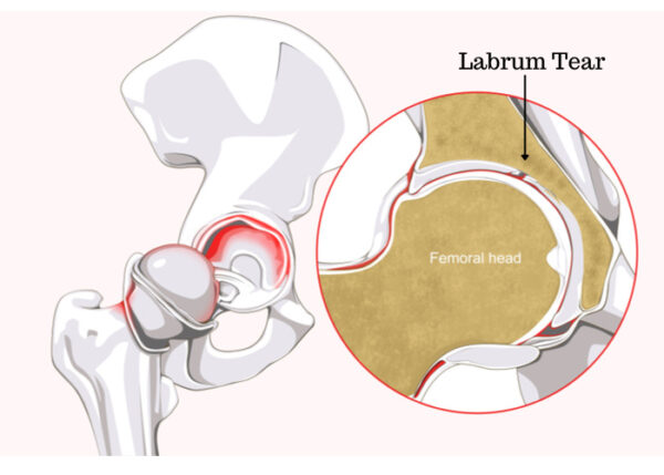 Patellar Tendon Repair Amarillo, TX  Patella Tendon Rupture Treatment  Amarillo