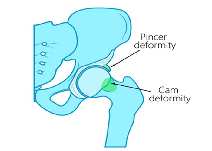 Cam Deformity Causing Impingement | Austin TX