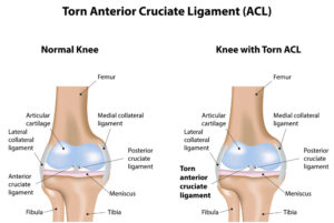 ACL Injury