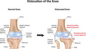 Knee Dislocation