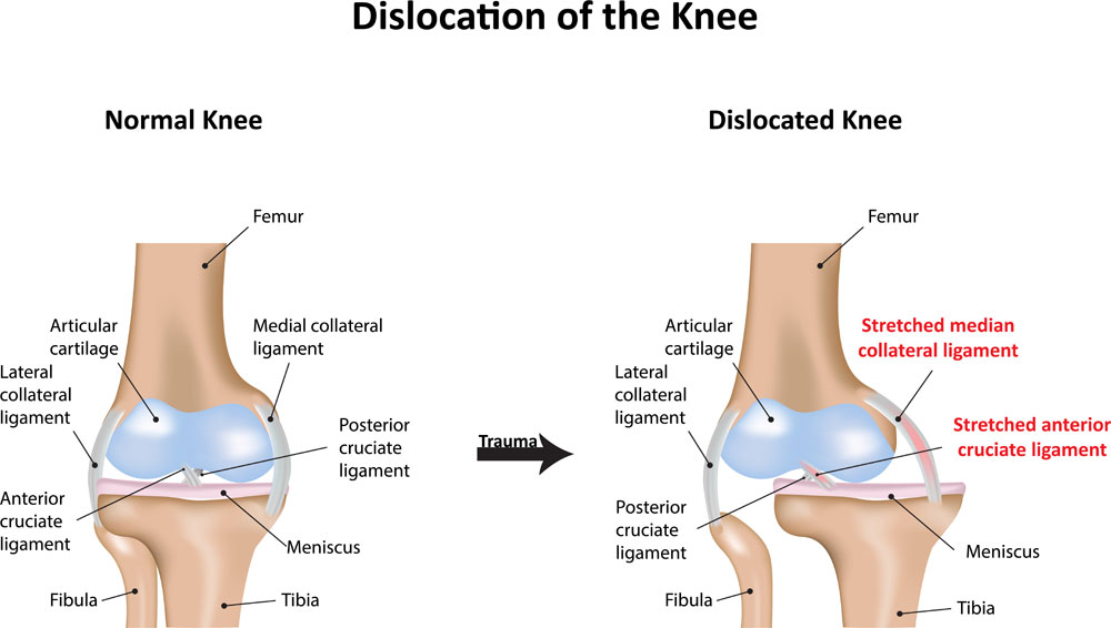 Multi-Ligament Knee Injuries Chicago, IL