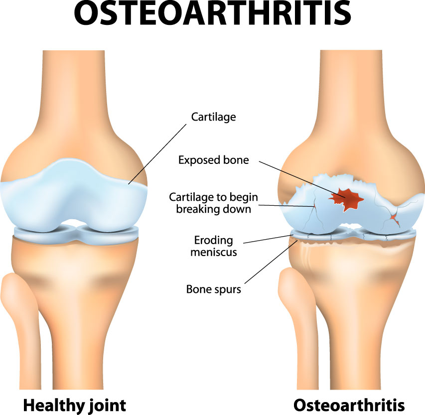 Knee Cartilage Injury | Knee Specialist | Austin, Round Rock ...