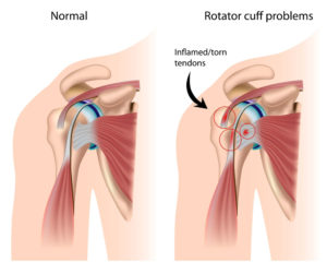 Rotator Cuff Injury